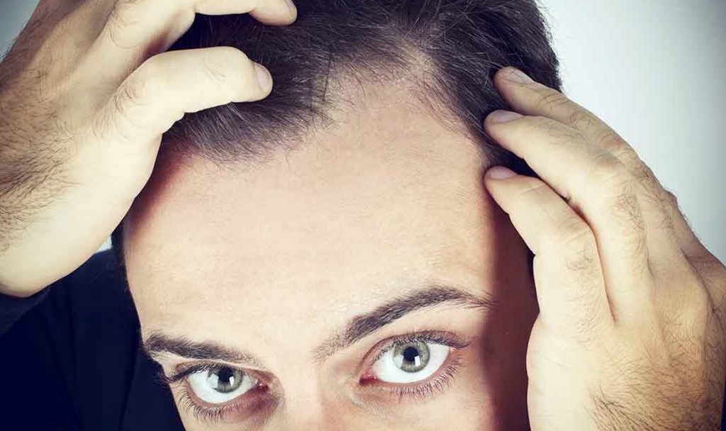 Men's hair loss