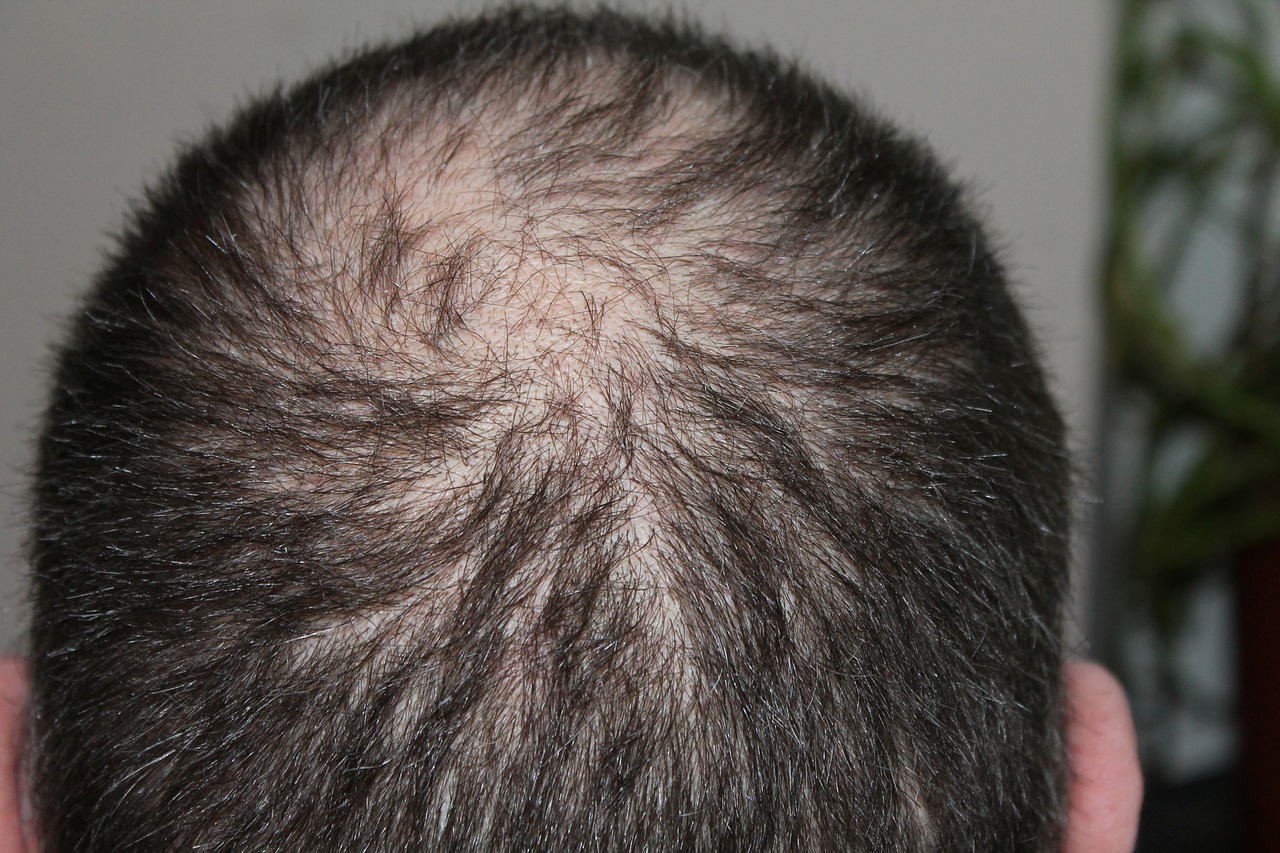 What is Alopecia Areata?